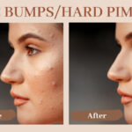 How to Deal with Acne and Pimples